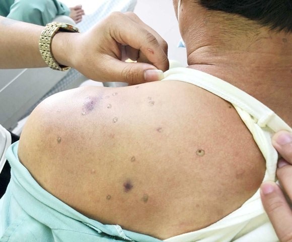 Người đàn ông bị ong đốt 40 phát ảnh 1 Nguoi dan ong bi ong dot 40 phat anh 1