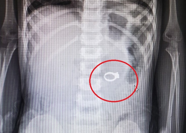 Chiec nhan trong bung be gai 4 tuoi anh 1