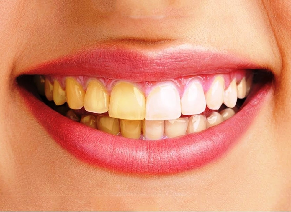 Tai sao rang bi o vang? hinh anh