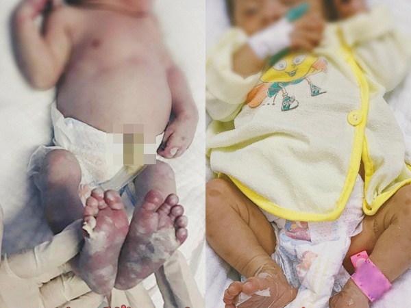 Benh giang mai bam sinh anh 1