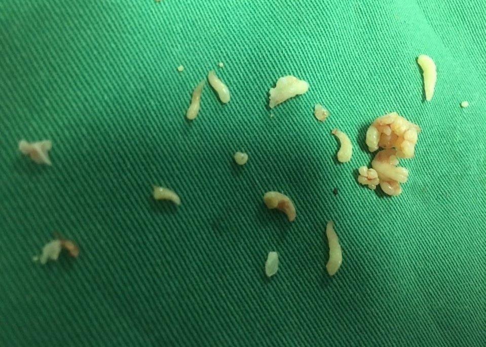 Bac si lay ra gan 20 chiec rang trong khoi u hinh anh