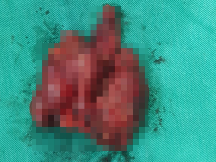 Phat hien ung thu do nuot kho anh 1