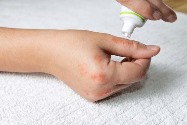 Benh do kien ba khoang anh 7