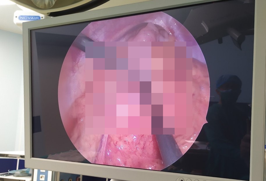 Ruot non nam tren khoang mang phoi hinh anh