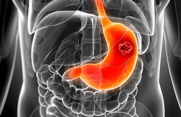 Dau hieu ung thu da day anh 3