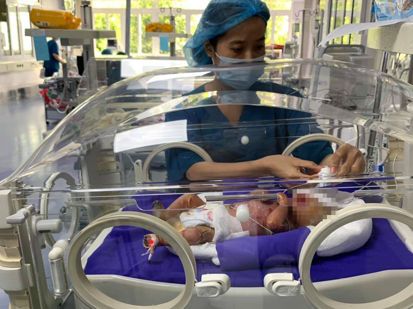 Bé sinh non da bị sừng hóa ảnh 1 Be sinh non da bi sung hoa anh 1