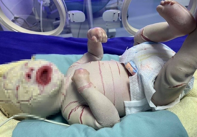 Be trai mac benh da vay ca duoc dieu tri the nao? hinh anh