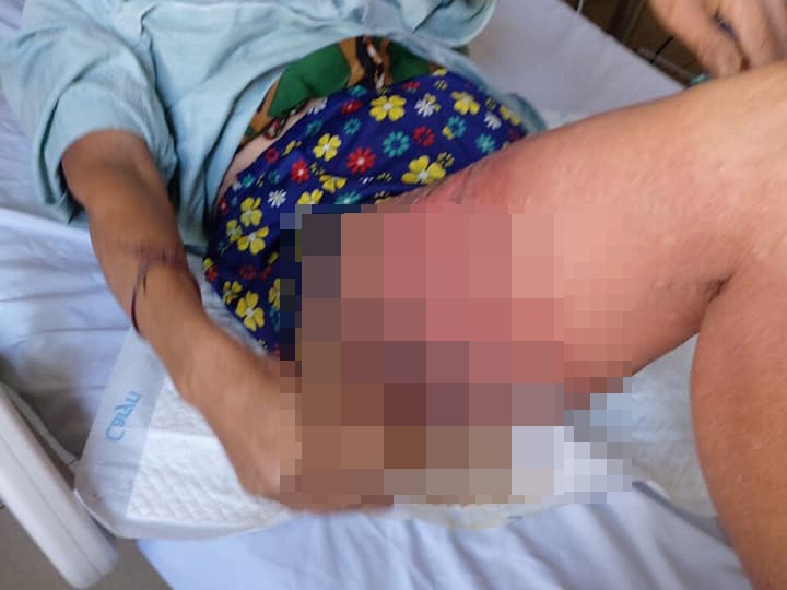 Nhiễm trùng vì dùng gừng đắp vào chân ảnh 1 Nhiem trung vi dung gung dap vao chan anh 1