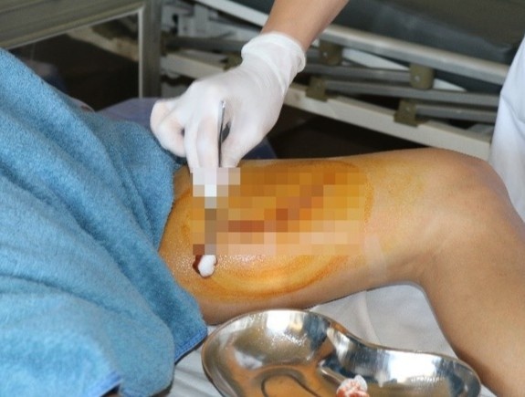 Binh ruou oi phat no khien nam thanh nien bi rach dui hinh anh