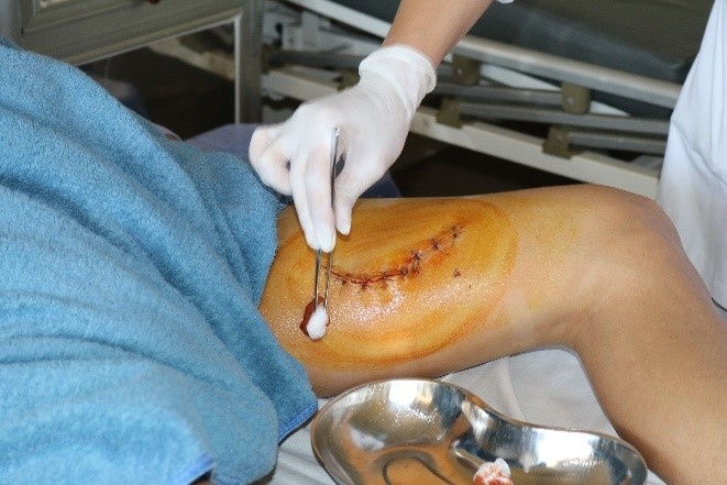 Rach hai dui vi no binh ruou oi anh 1