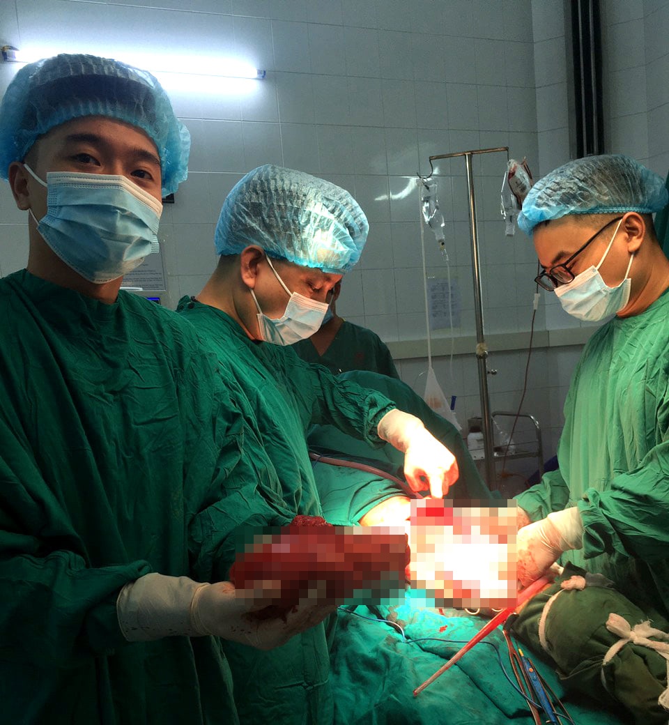 Khối u gần 2 kg trên đùi ảnh 1 Khoi u gan 2 kg tren dui anh 1