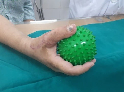 Nam thanh nien duoc ghep ngon chan thanh ngon tay cai hinh anh