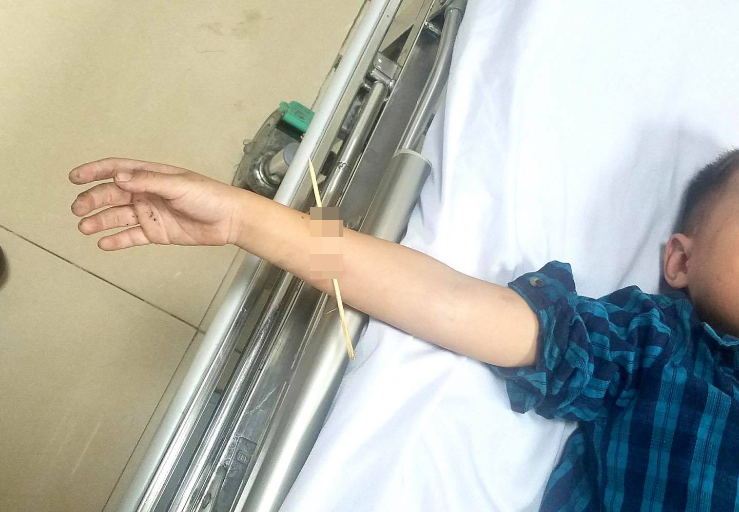 cay xien thit dam xuyen cang tay anh 1