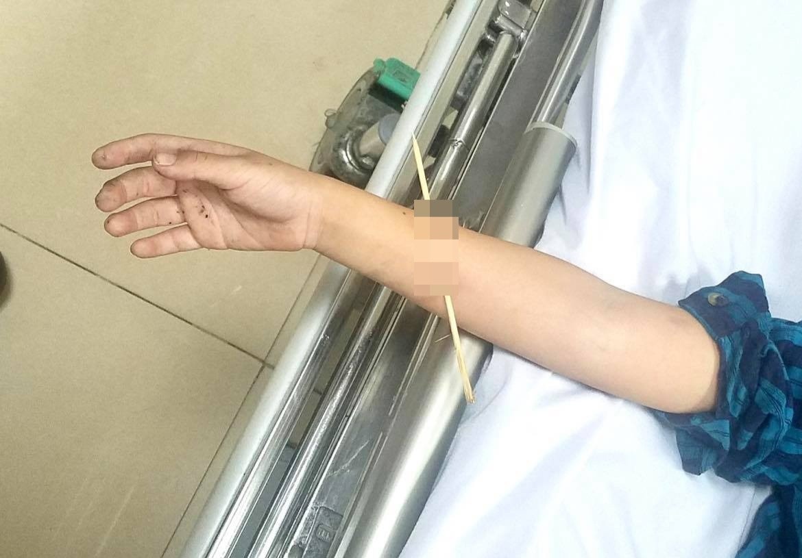 Be trai bi que tre dam xuyen cang tay hinh anh