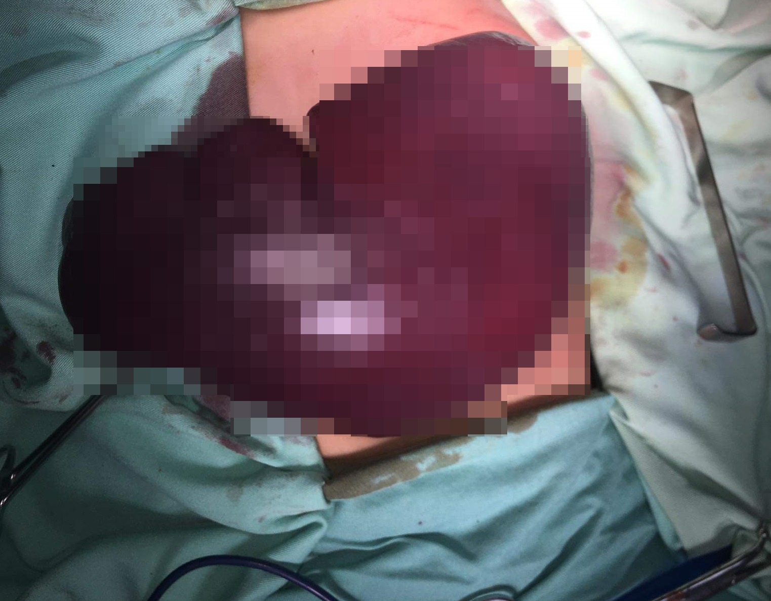 Trẻ có lá lách khổng lồ ảnh 1 Tre co la lach khong lo anh 1