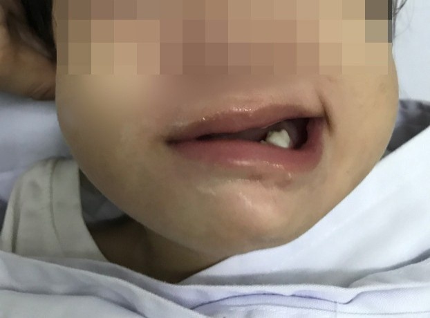 Be gai 17 thang tuoi bi meo mieng hinh anh