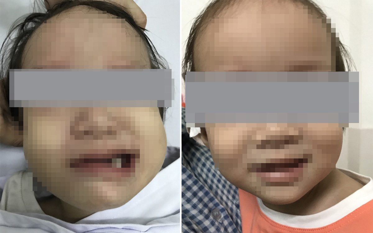 Bé gái bị méo miệng ảnh 1 Be gai bi meo mieng anh 1