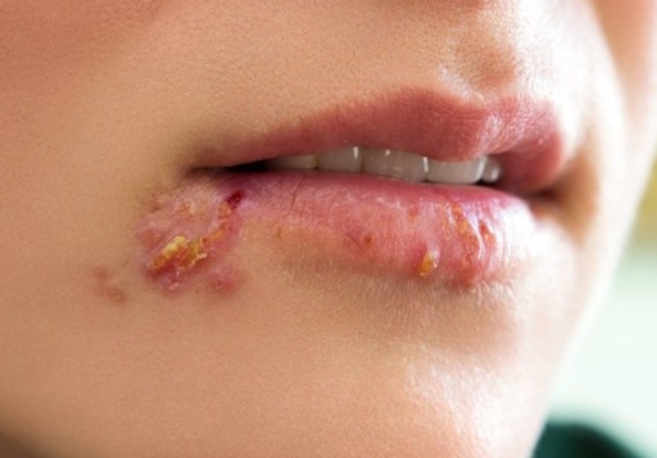 Nhung bien chung nguy hiem cua benh gioi leo hinh anh