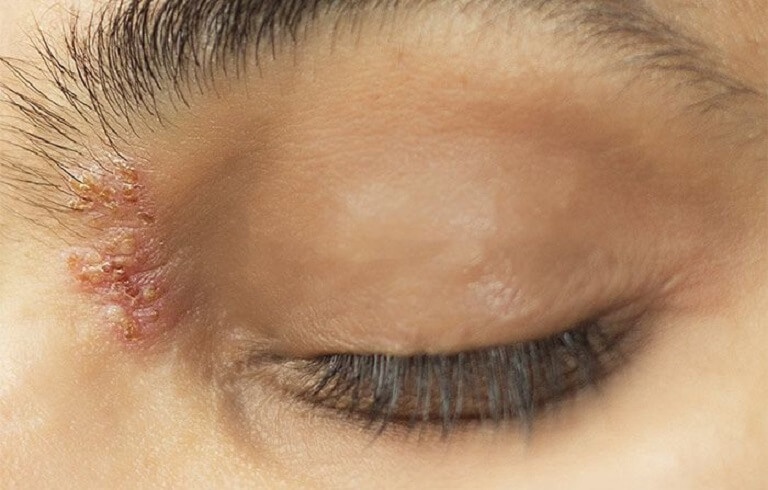 bien chung cua gioi leo anh 2