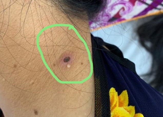 Dau hieu benh sot mo anh 2