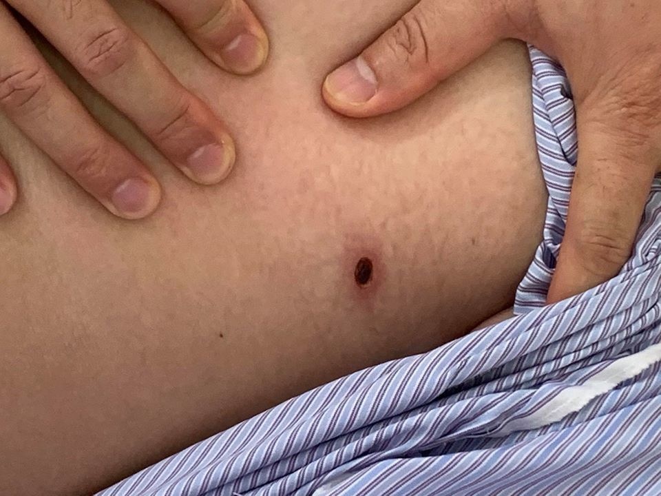 Vet loet nho tren da la dau hieu benh nguy hiem hinh anh