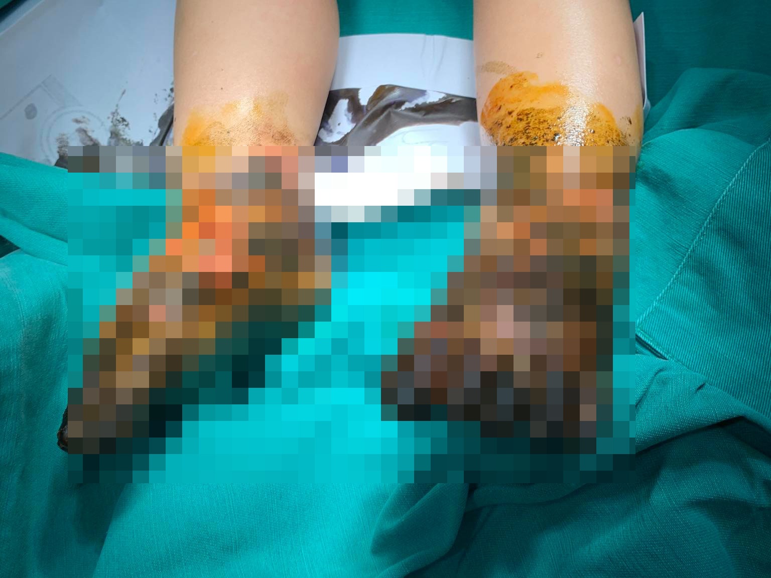 Be trai bi nhiem trung nang hai chan vi dap thuoc nam hinh anh