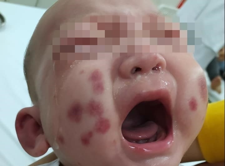 Be trai mac benh hiem, lan dau ghi nhan o Viet Nam hinh anh