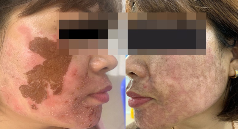Bỏng da vì dùng hóa chất trị nám  ảnh 1 Bong da vi dung hoa chat tri nam anh 1
