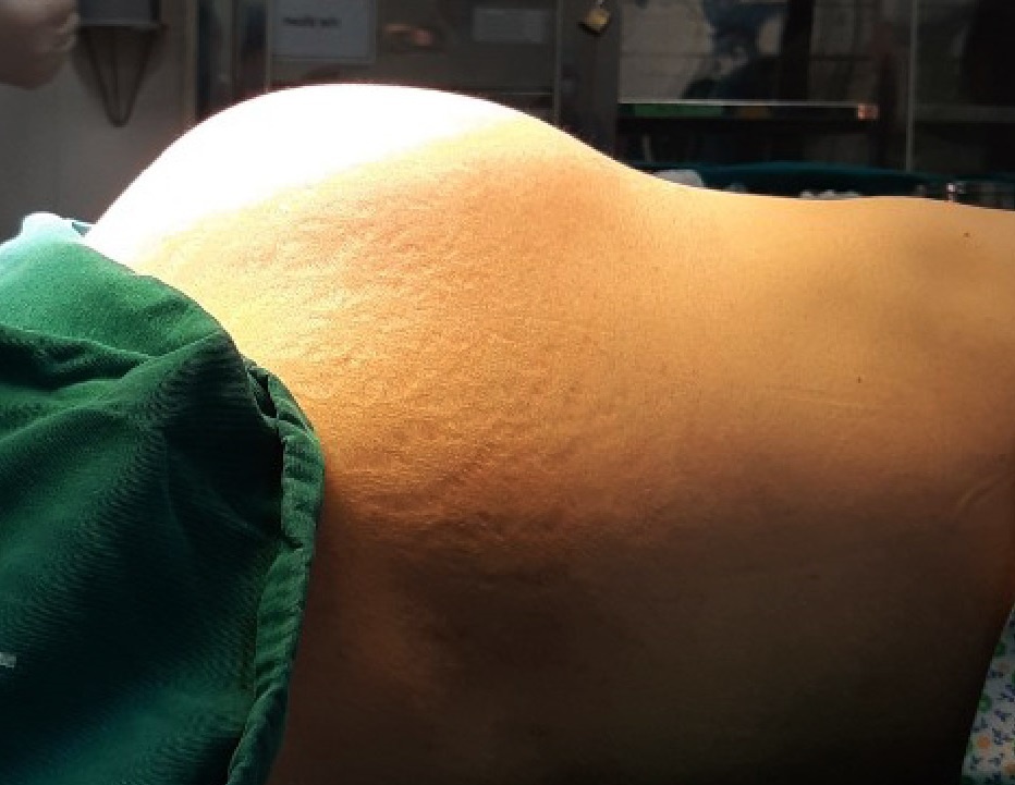 Khoi u xo tuong duong thai 9 thang anh 1