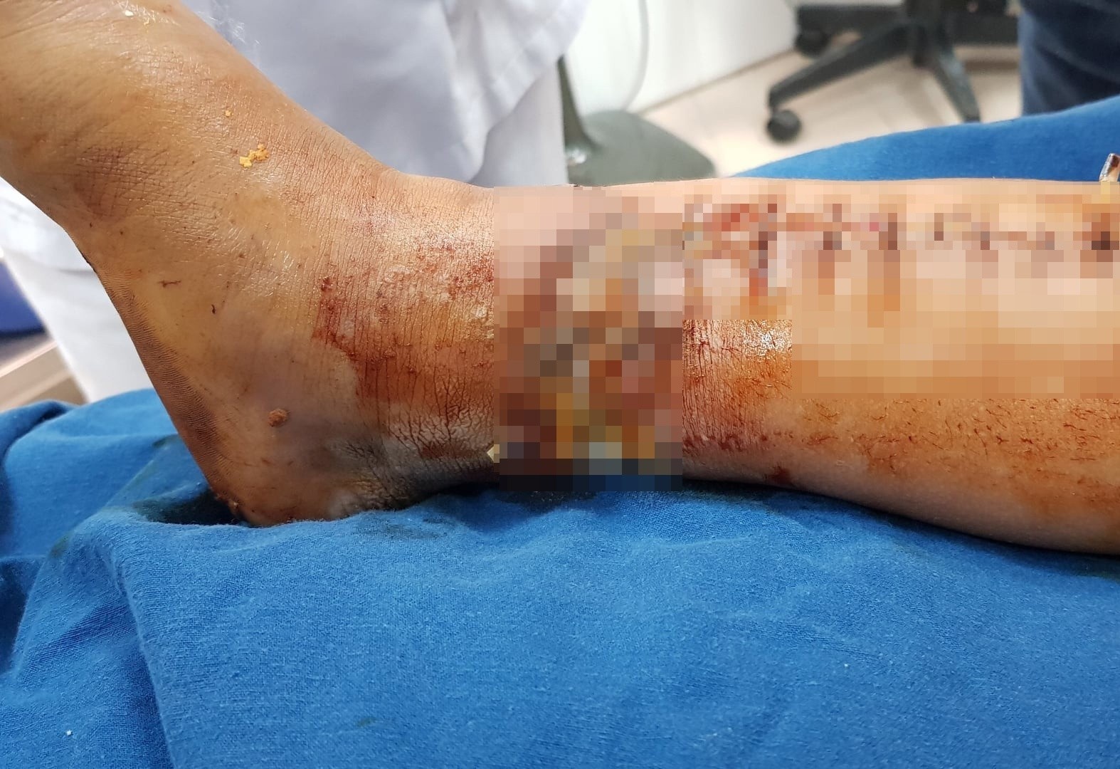 Be trai bi may xuc lam dap nat chan hinh anh