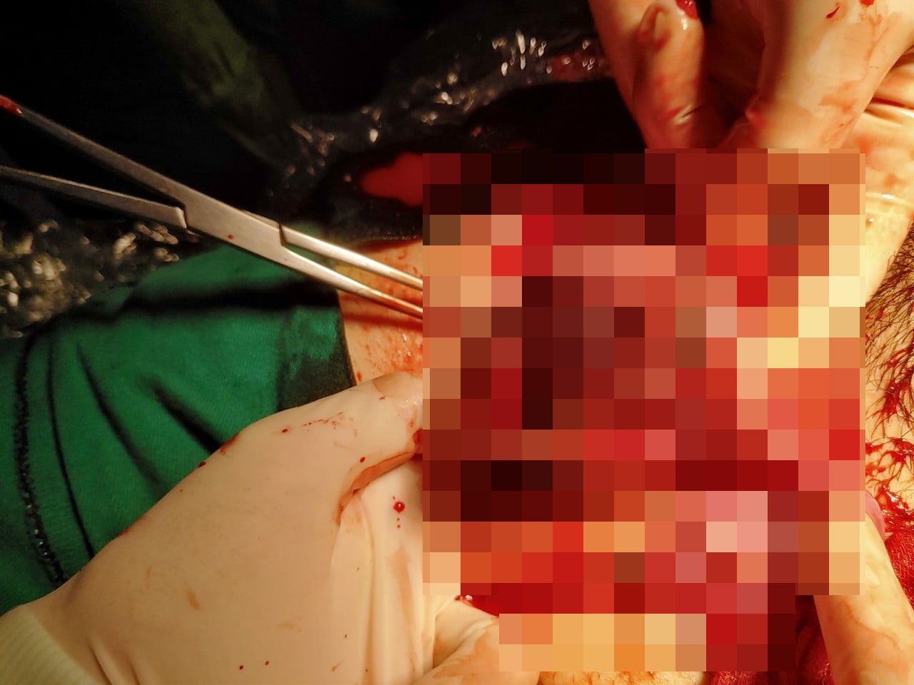 Vỡ tử cung trên vết mổ đẻ cũ ảnh 1 Vo tu cung tren vet mo de cu anh 1