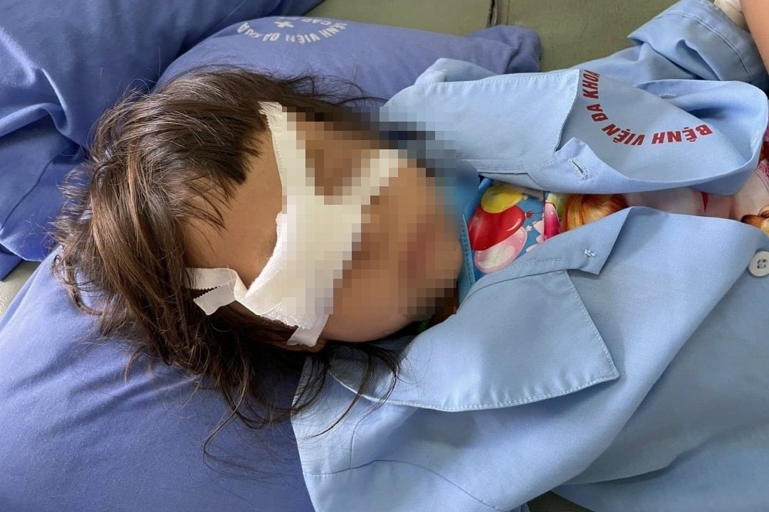 Be gai bi vo nhan cau do cay choc vao mat hinh anh