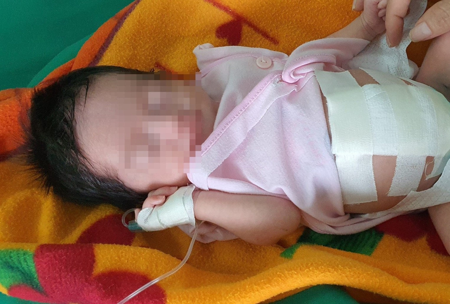 Be so sinh co duong ruot nam ngoai o bung hinh anh