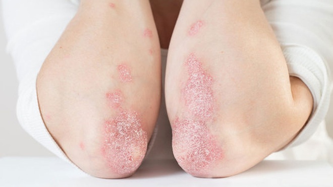 Benh nhan vay nen co nen tiem vaccine phong Covid-19? hinh anh