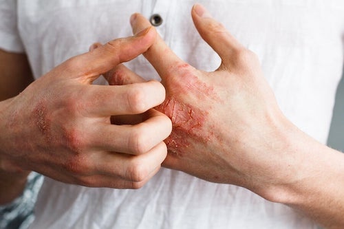Điều trị vảy nến ảnh 2 Dieu tri vay nen anh 2