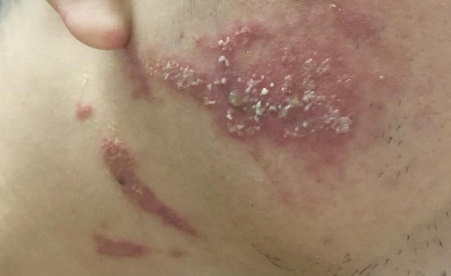 Viem da tiep xuc do kien ba khoang anh 2