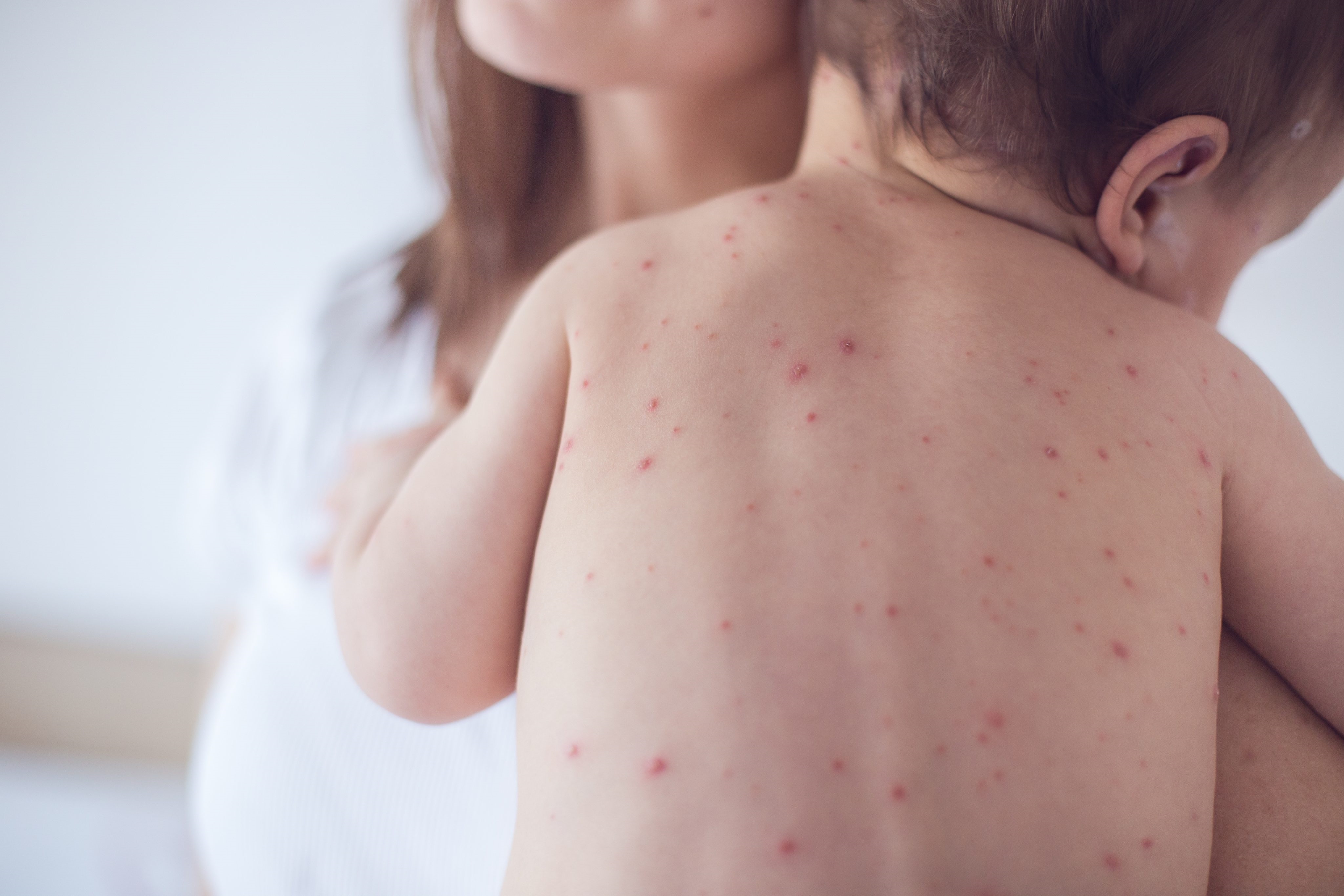 điều trị sốt xuất huyết cho trẻ ảnh 1 dieu tri sot xuat huyet cho tre anh 1