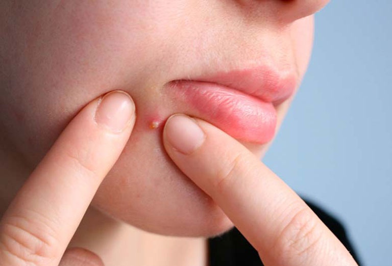 Cach xu ly khi bi nhot hinh anh