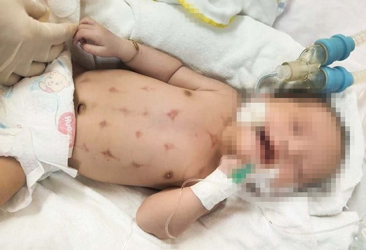 Be so sinh nguy kich sau khi nam than, chich sai den hinh anh