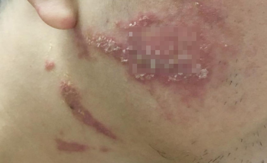 cach xu tri khi kien ba khoang dot anh 1