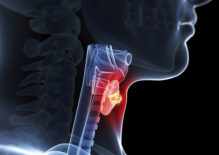 dau hieu canh bao benh ung thu tuyen giap tre em anh 2