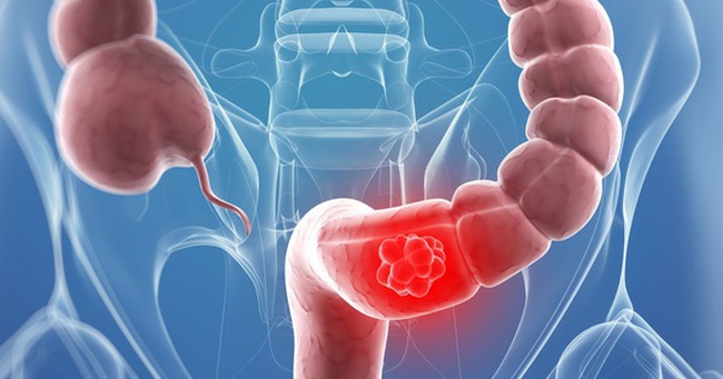 trieu chung ung thu dai trang giai doan cuoi anh 1