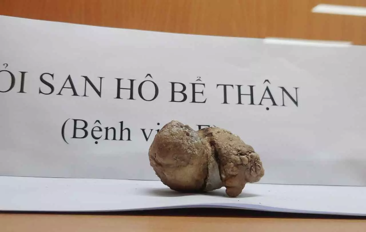 thận mất hoàn toàn chức năng ảnh 1 than mat hoan toan chuc nang anh 1