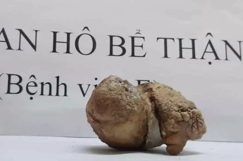 Thoi quen thuong gap khien than mat hoan toan chuc nang hinh anh
