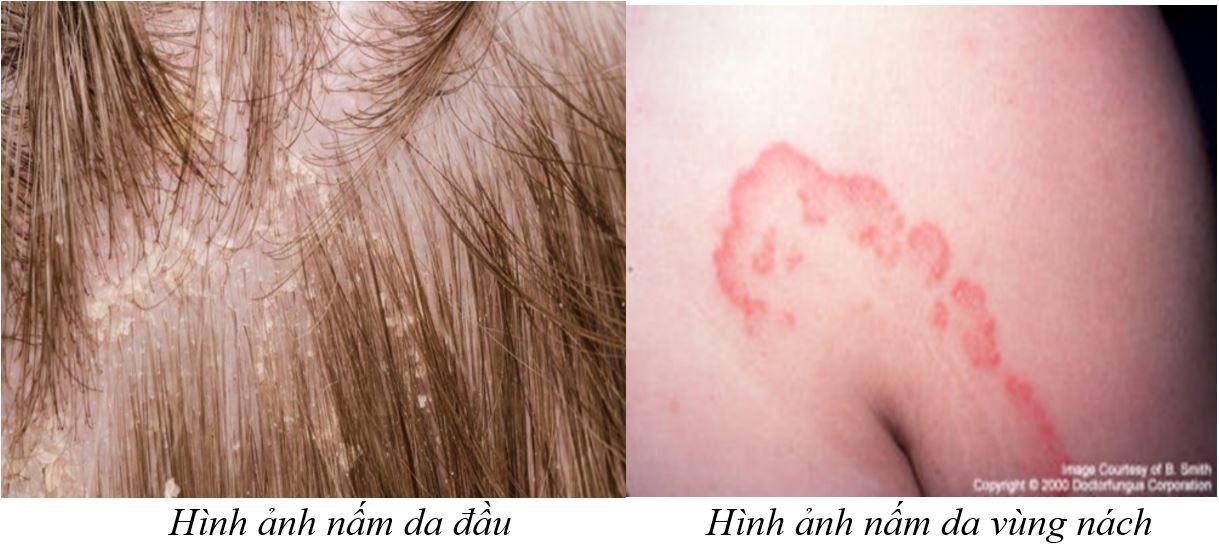 benh nam da vao mua he anh 1