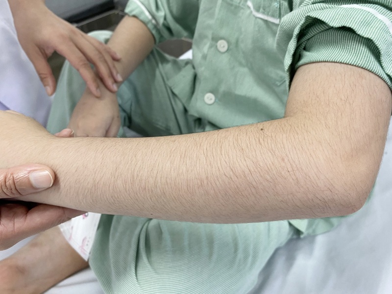 Be 10 tuoi moc day long do dung thuoc xit mui sai cach hinh anh