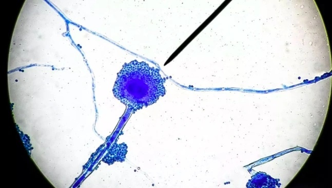 Bi an ve loai nam den gay hoai tu xuong ham hinh anh