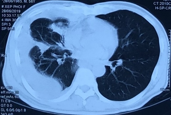 Phat hien ung thu phoi giai doan 4 sau con dau nguc anh 1