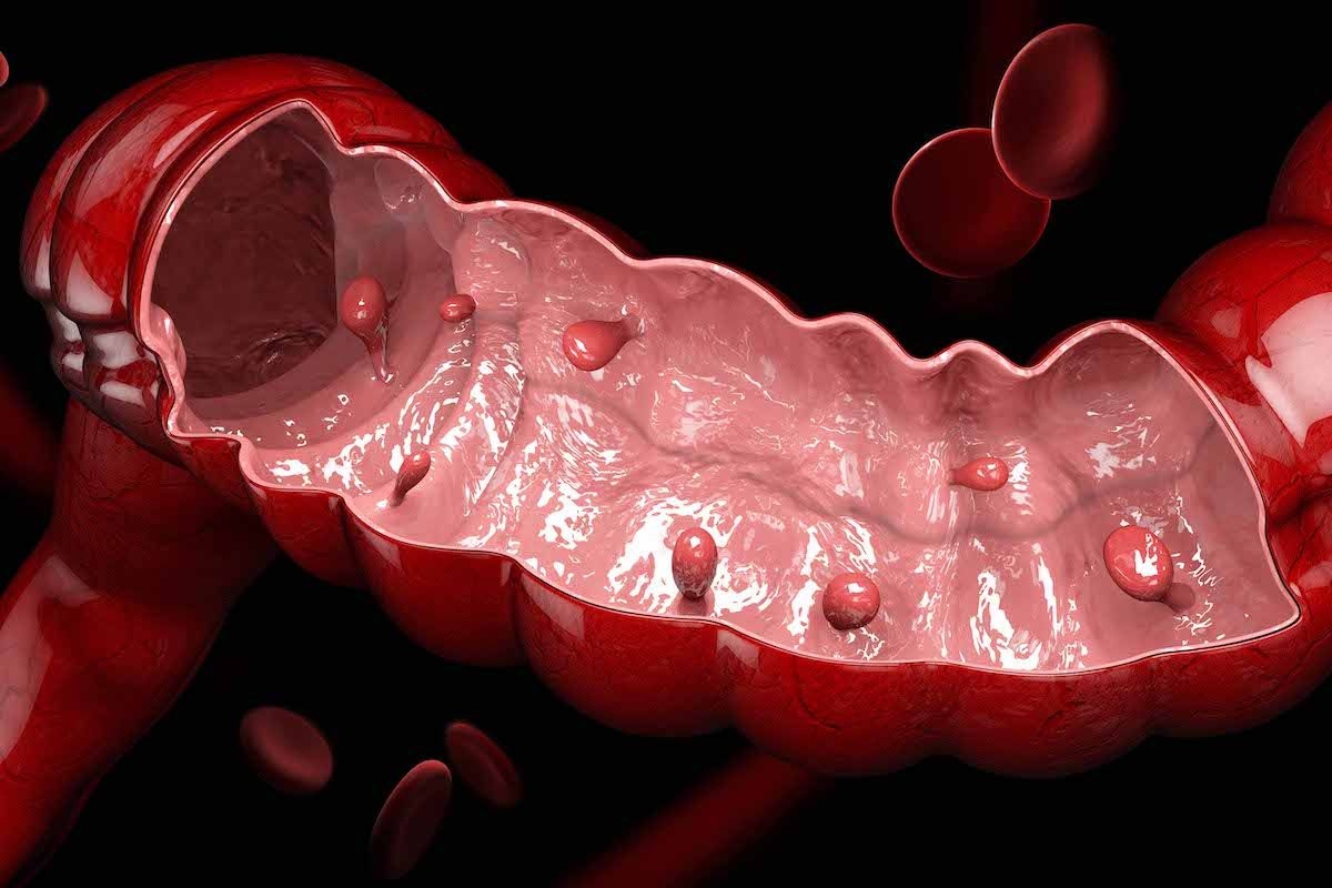 dau hieu chuan xac ung thu dai truc trang anh 1