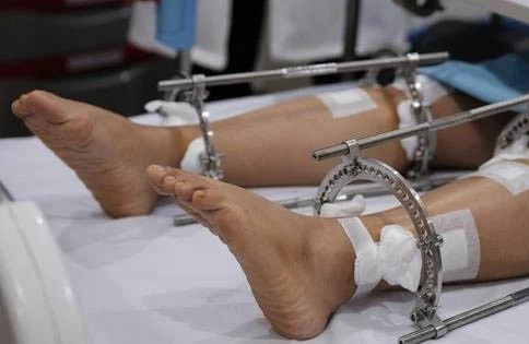 Chang trai 23 tuoi duoc keo dai chan them 18 cm hinh anh